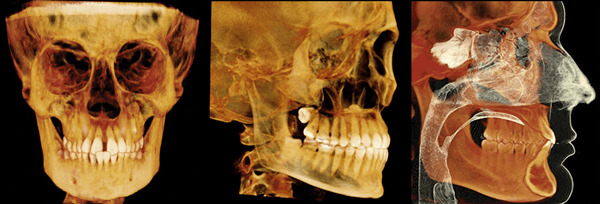 Dental implants